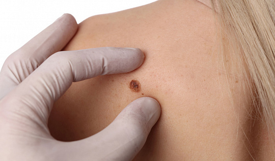 24 мая отмечается день диагностики меланомы