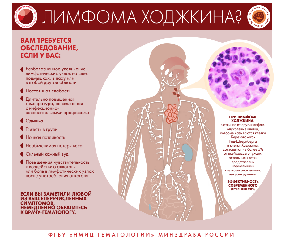 Признаки и симптомы неходжкинской лимфомы