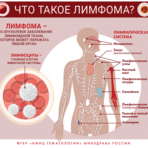 Признаки и симптомы неходжкинской лимфомы